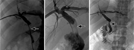 Endoscopic and PTC Stricture Management