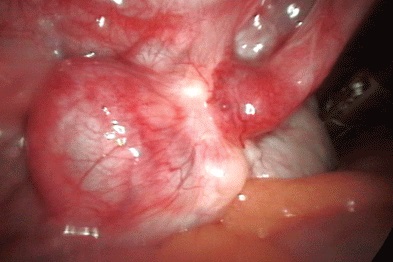 Pelvic Inflammatory Disease - Laparoscopy