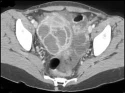 Tubo-Ovarian Abscess - CT Scan