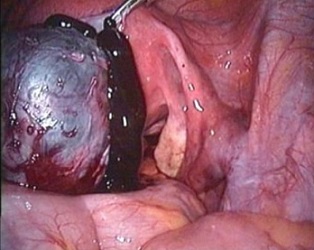 Endometrioma - Laparoscopy