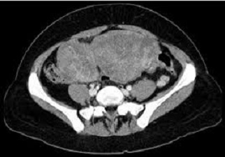 Ovarian Metastasis - Krukenberg Tumor