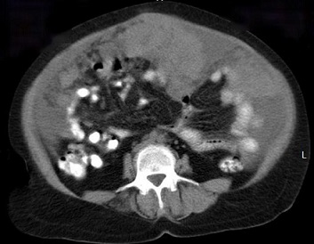 Ovarian Carcinomatosis