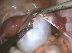 Simple Ovarian Cyst