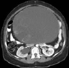 Ovarian Mucinous Cystadenoma