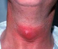 Infected Thyroglossal Duct Cyst