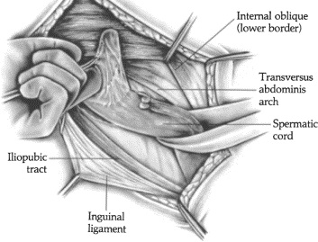 Iliopubic_tract