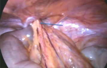 Incarcerated Femoral Hernia - Laparoscopy