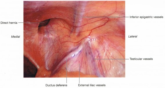 Laparoscopic View of a Direct Hernia