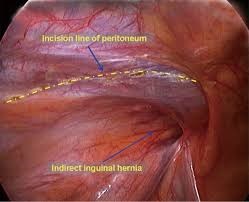 Laparoscopic View of an Indirect Hernia