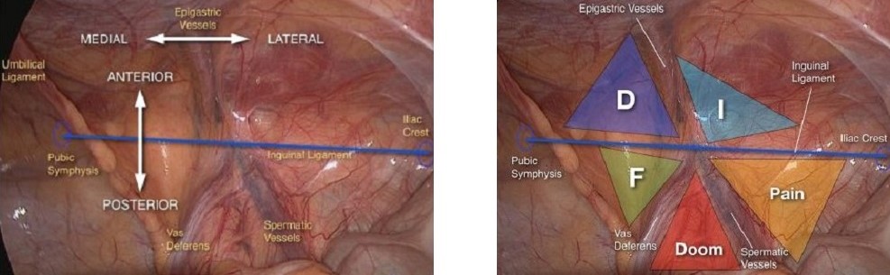 Laparoscopic View of the Inguinal Region