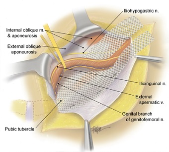 Lichtenstein (Tension-Free) Repair