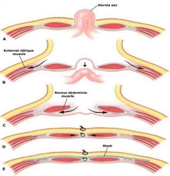 Anterior Component Separation