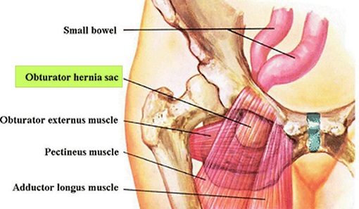 Obturator Hernia