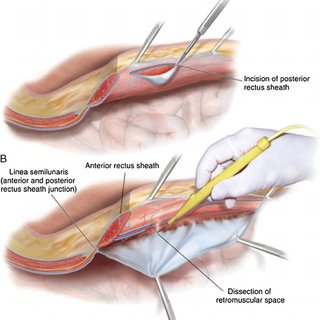 Posterior Component Separation