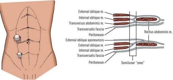 Spigelian Hernia