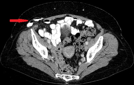 CT - Spigelian Hernia