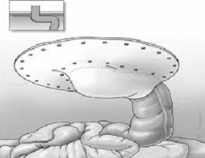 Sugarbaker Procedure for Parastomal Hernia Repair