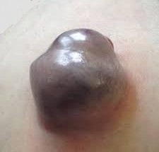 Umbilical Hernia in a cirrhotic