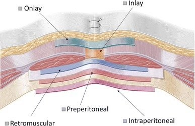 Ventral Hernia Mesh Locations