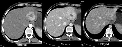 CT Scan Focal Nodular Hyperplasia