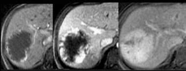 Liver Hemangioma MRI