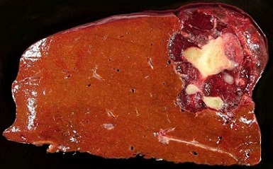 Gross Liver Hemangioma