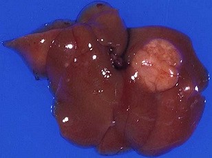 Liver Adenoma