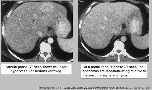 Liver Adenoma CT Scan