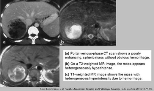 Liver Adenoma MRI