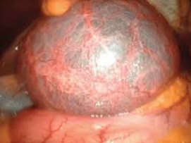 Benign Liver Cyst