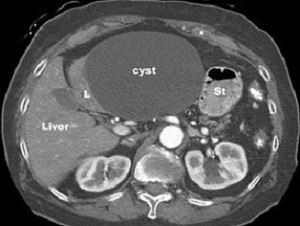 Benign Liver Cyst CT Scan