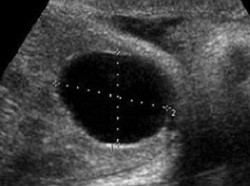 Benign Liver Cyst Ultrasound