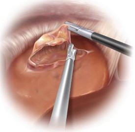 Liver Cyst Fenestration