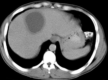 Amebic Liver Abscess