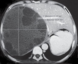 CT Scan of Hydatid Cyst