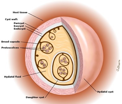 Hydatid Cyst Structure