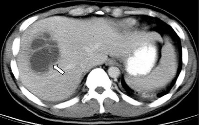 CT Scan of Pyogenic Liver Abscess