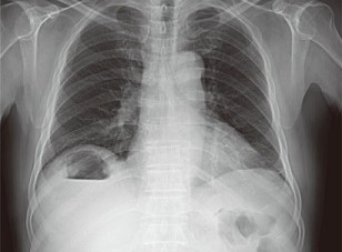 Pyogenic Liver Abscess with Subdiaphragmatic Air-Fluid Level