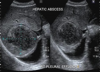 Ultrasound of Pyogenic Liver Abscess