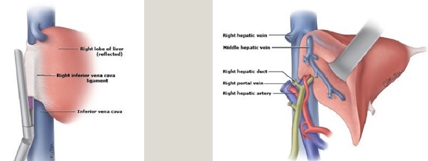 IVC Vein Division and Right Hepatectomy