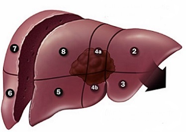 Extended Left Hepatectomy