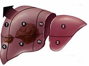 Extended Right Hepatectomy