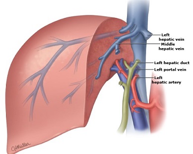 Left Hepatectomy