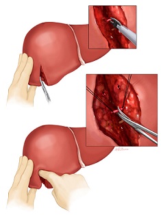 Parenchymal Transection