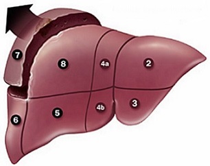 Liver Segmentectomy