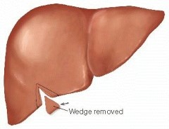 Liver Wedge Resection