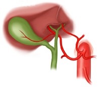 Replaced Left Hepatic Artery