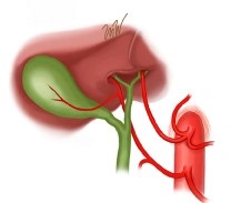 Replaced Right Hepatic Artery