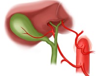 Replaced Right and Left Hepatic Arteries