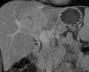 MRI - Fibrolamellar Carcinoma